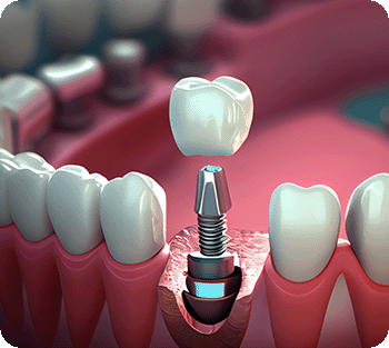 Implantatzahn