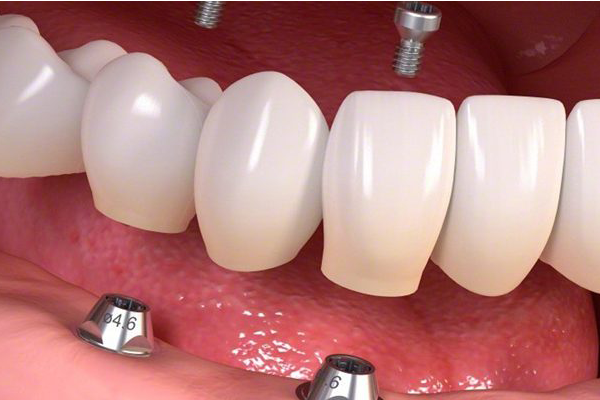 Implantatprothese