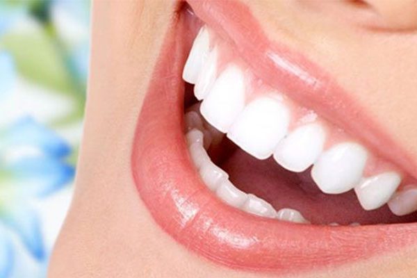 Dentalveneer aus Porzellan